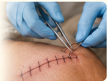 Suture / Staple Removal
